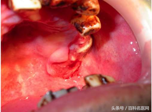 判断嚼槟榔口腔癌最简单方法,嚼槟榔口腔癌最严重的患者
