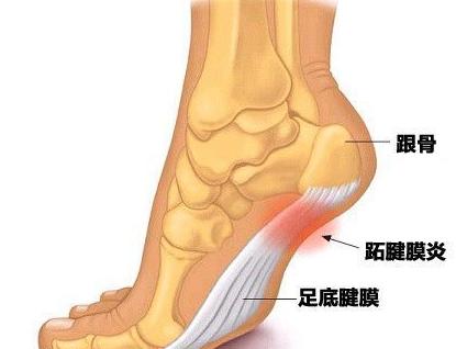 脚后跟摸着不疼踩着就疼是啥原因,走路多脚后跟疼是什么原因引起的