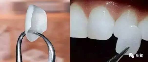 林允整牙却像整容？她是真的又整了啊！