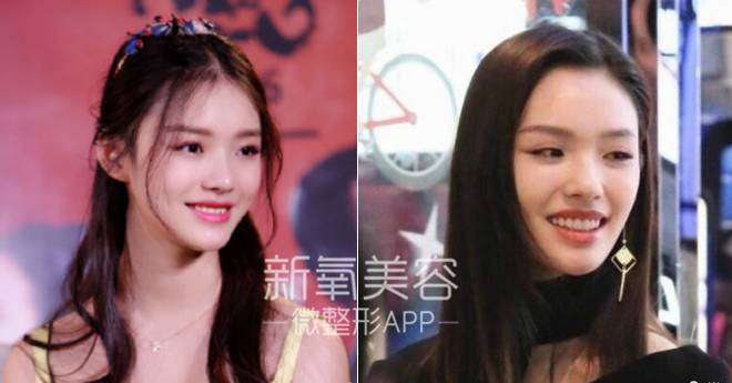 林允整牙却像整容？她是真的又整了啊！