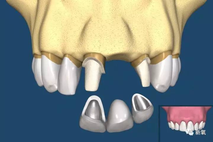 林允整牙却像整容？她是真的又整了啊！