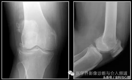 软组织钙化与骨化,软组织钙化和骨质增生
