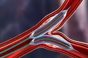 糖尿病性冠心病，如何治疗？