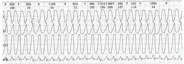 与肢端肥大有关的病症,肢端肥大症的别名