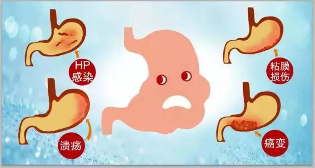 「健康」胃胀、胃酸很难受？专家助你打好健康保“胃”战！