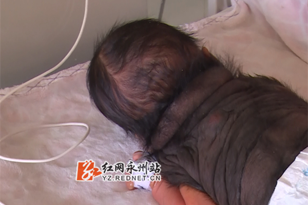 河北一岁大男童患兽皮痣,宁远县男婴