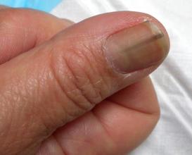 指甲都会有什么病症,指甲也会病变么