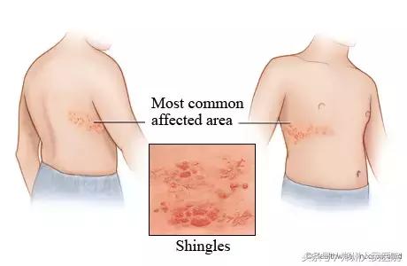 中医刘天鹏医生讲带状疱疹,陈明教授治带状疱疹