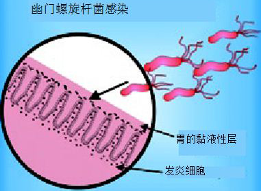 专家推荐治疗幽门螺杆菌,专家治疗幽门螺杆菌药方