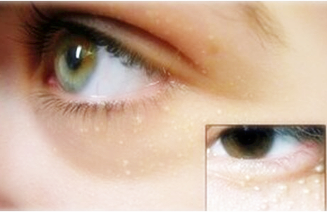 长了脂肪粒会自己脱落吗,长了脂肪粒用什么护肤品