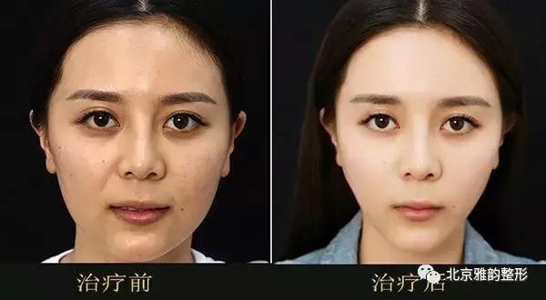 做超声刀要提前做什么准备,超声刀最佳效果时间