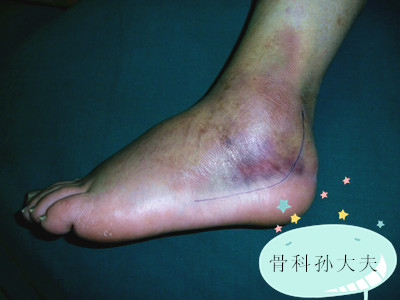 摔伤肿了可以揉吗,受伤后肿胀有点痒为什么