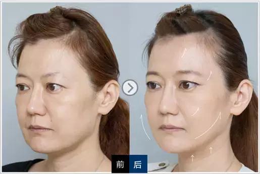 做超声刀要提前做什么准备,超声刀最佳效果时间