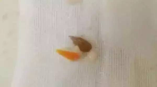 小孩吃东西噎住急救方法图,小孩吃瓜子噎死