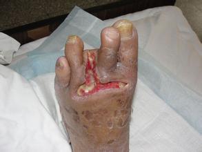 糖尿病并发症一旦产生，药物治疗很难逆转