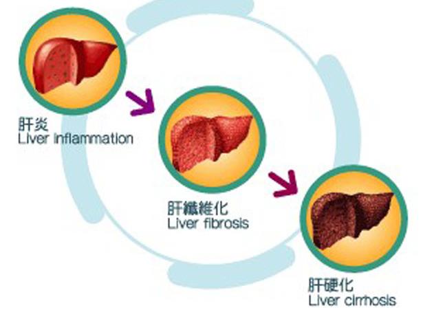 余祖江治肝炎,郑大一附院感染科余祖江挂号