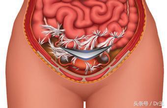 剖腹产后出现黏连常有的事，这么做有备无患！
