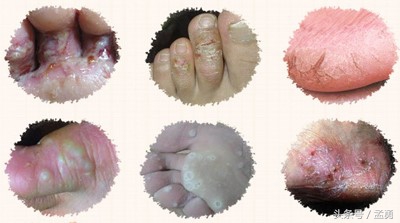 珍爱生命远离脚气 (左脚脚气怎么消除)