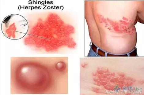 中医刘天鹏医生讲带状疱疹,陈明教授治带状疱疹