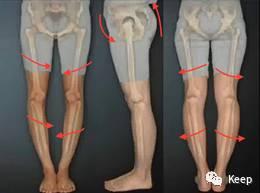 婴儿o型腿怎么矫正最有效的方法,o型腿怎么通过运动矫正