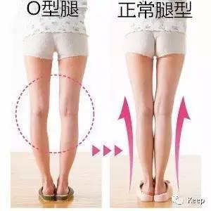 婴儿o型腿怎么矫正最有效的方法,o型腿怎么通过运动矫正