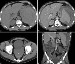 手术患者跌倒坠床,手术过程中摔下手术台