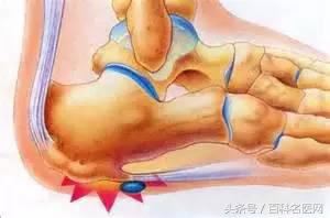 脚后跟疼不走路也疼怎么回事,小孩脚后跟疼不红不肿是什么原因