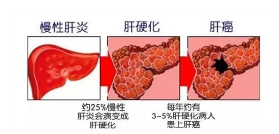 余祖江治肝炎,郑大一附院感染科余祖江挂号