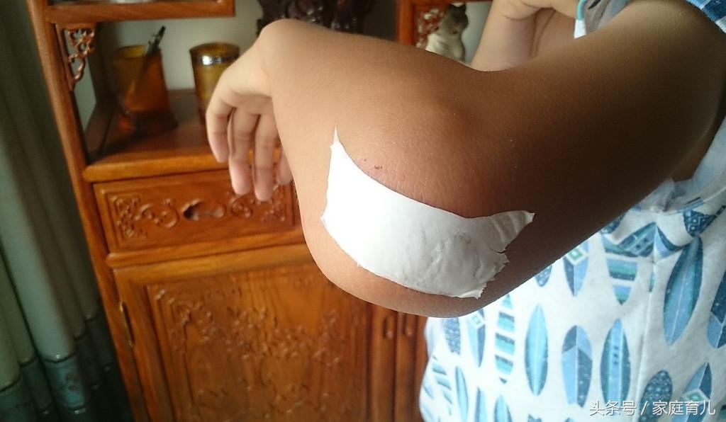 宝宝擦伤破皮出血需要打碎伤风吗,宝宝蹭破皮流血怎么处理