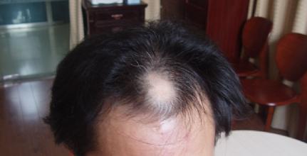 赵炳南治疗脂溢性脱发,赵炳南治疗脂溢性脱发的中药药方