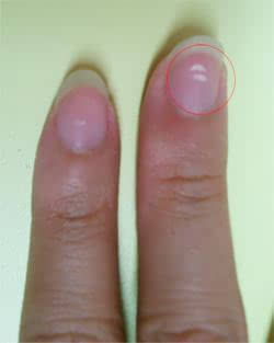 指甲都会有什么病症,指甲也会病变么