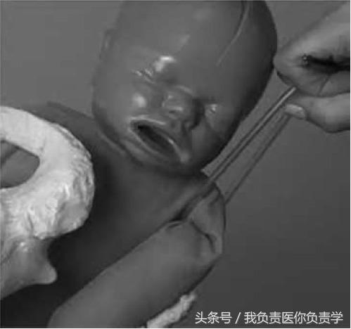 肩难产演练视频全部过程,产妇出现肩难产视频