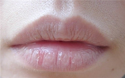 小孩嘴唇干裂是什么原因引起的,嘴唇干裂起皮鼻孔也干是什么原因