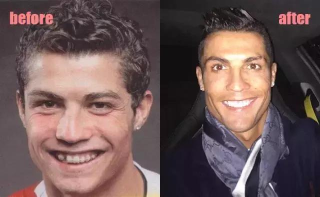 整牙刘涛,整牙改变脸型杨幂