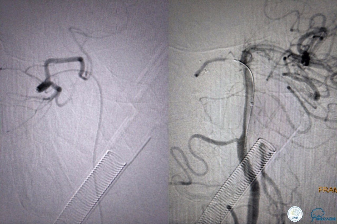 一例急性基底动脉尖综合征患者的支架取栓治疗