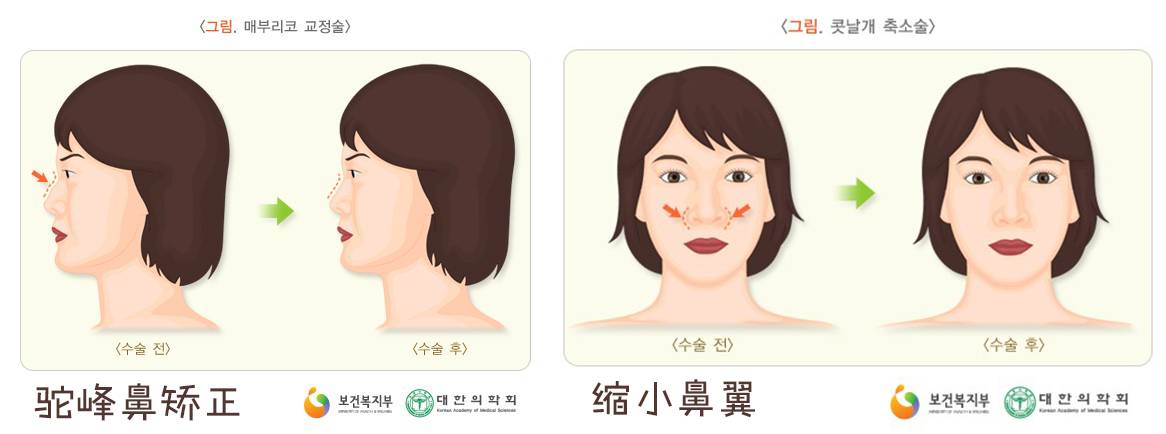 割双眼皮、垫鼻子、幽灵医生……一篇文章为你揭秘韩国整形