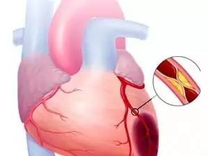 糖尿病性冠心病，如何治疗？