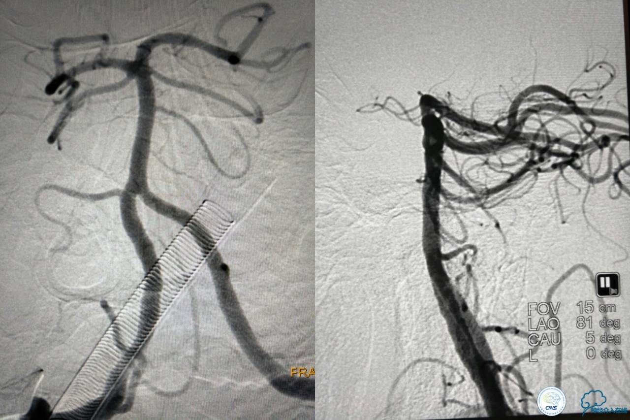 一例急性基底动脉尖综合征患者的支架取栓治疗