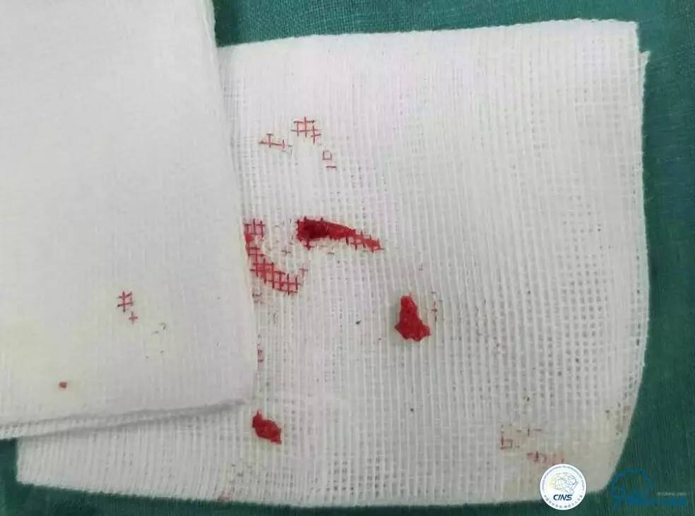 一例急性基底动脉尖综合征患者的支架取栓治疗