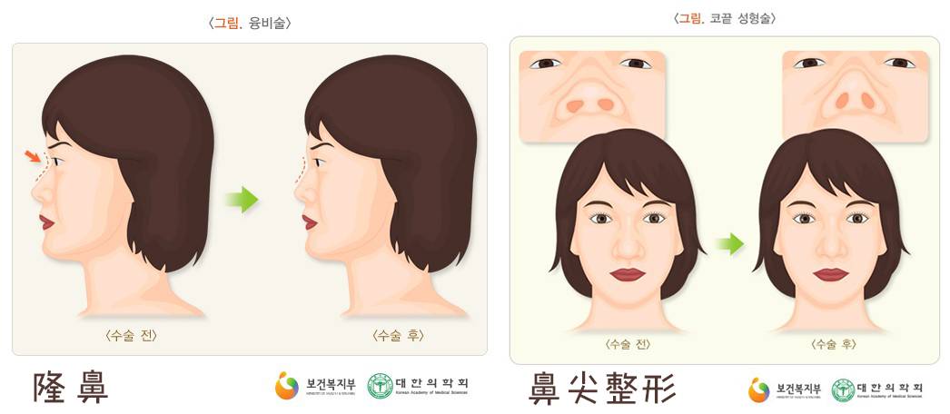割双眼皮、垫鼻子、幽灵医生……一篇文章为你揭秘韩国整形