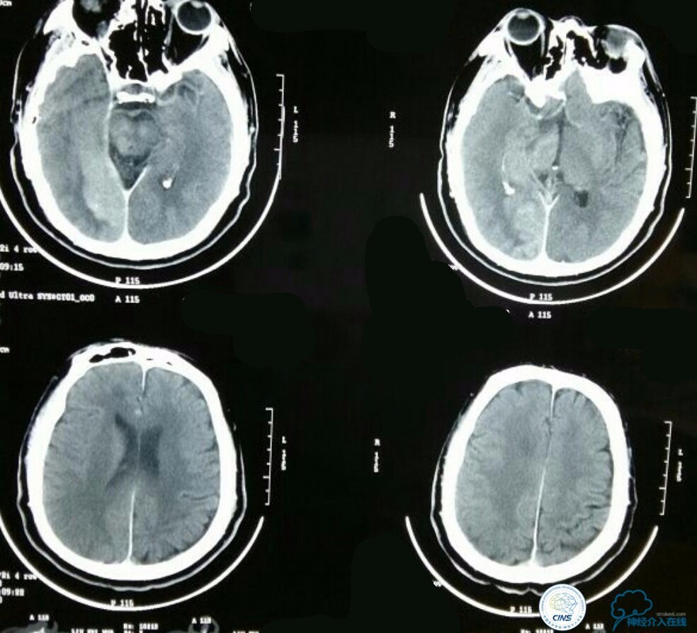 一例急性基底动脉尖综合征患者的支架取栓治疗