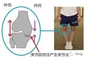 婴儿o型腿怎么矫正最有效的方法,o型腿怎么通过运动矫正