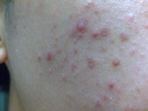 青春期痘痘如何防治,男生长痘痘用什么方法最快消除