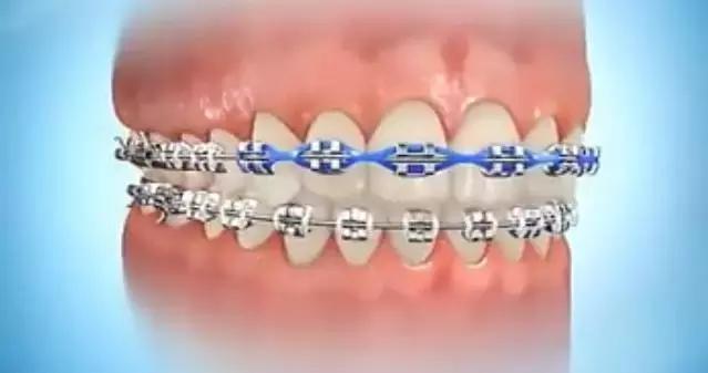 牙缝大矫正多少钱,小孩牙缝大怎么矫正