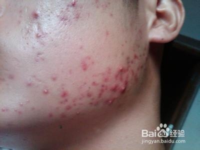 青春期痘痘如何防治,男生长痘痘用什么方法最快消除