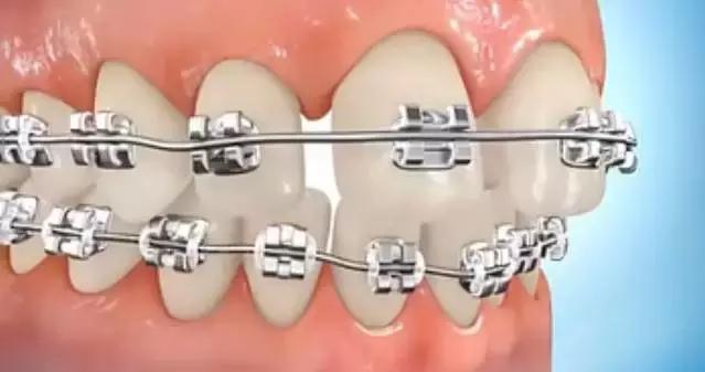 牙缝大矫正多少钱,小孩牙缝大怎么矫正