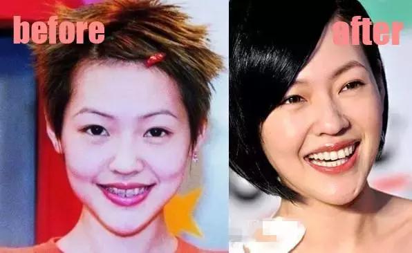 整牙刘涛,整牙改变脸型杨幂