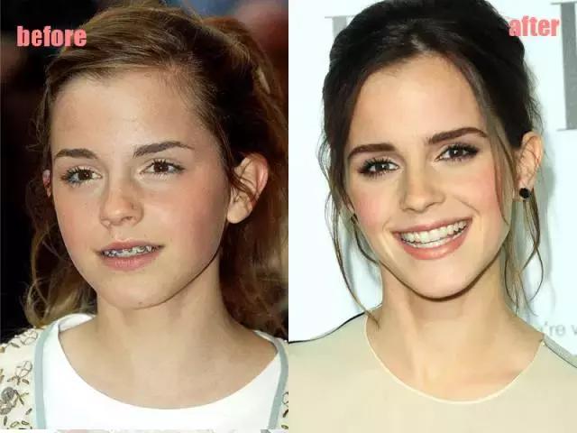 整牙刘涛,整牙改变脸型杨幂