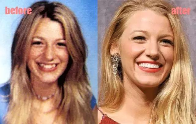 整牙刘涛,整牙改变脸型杨幂