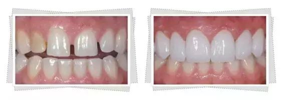 整牙刘涛,整牙改变脸型杨幂